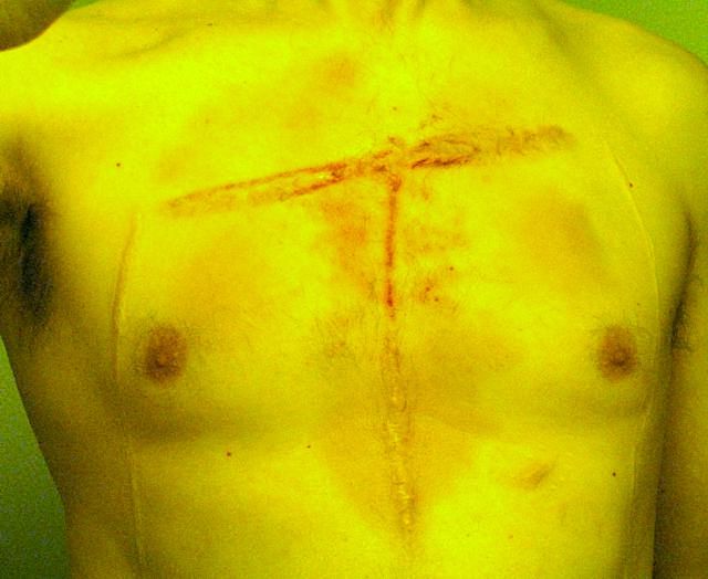 Scarification stabbing surgery beating